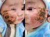 Bé trai 4 tháng tuổi nhập viện do đắp lá thuốc nam tự chữa viêm da tại nhà