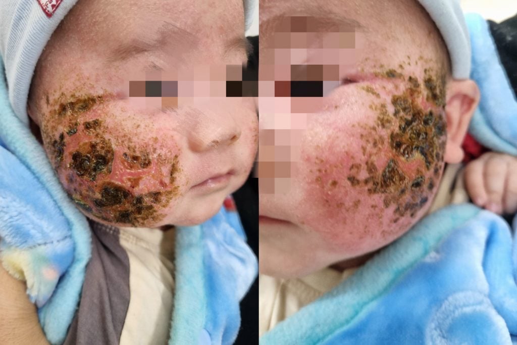 Bé trai 4 tháng tuổi nhập viện do đắp lá thuốc nam tự chữa viêm da tại nhà
